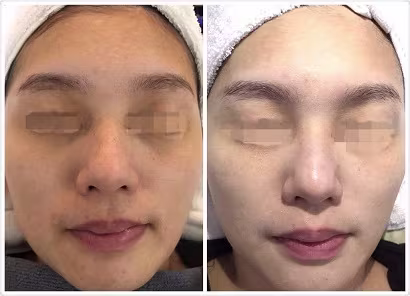 BB Glow Facial Treatment Promotion BB Glow Facial Treatment Promotion
