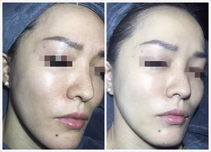 BB Glow Facial Treatment Promotion BB Glow Facial Treatment Promotion